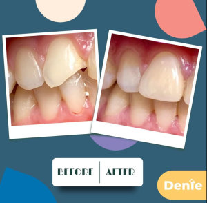 преди и след бондинг, predi i sled bonding, before and after dental bonding teeth
